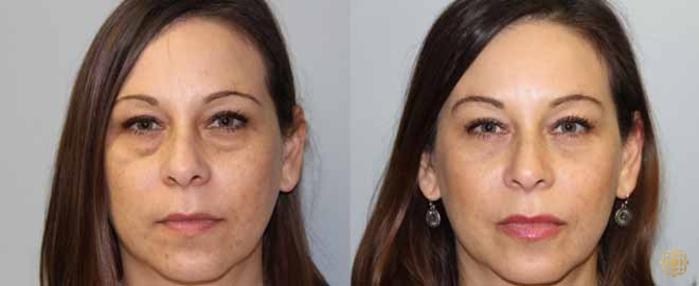 Before & After Blepharoplasty Case 207 View #1 View in Newport Beach, CA