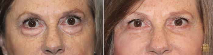 Before & After Blepharoplasty Case 208 View #1 View in Newport Beach, CA