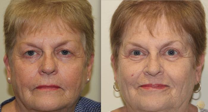 Before & After Blepharoplasty Case 211 View #1 View in Newport Beach, CA