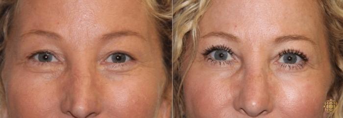 Before & After Blepharoplasty Case 216 View #1 View in Newport Beach, CA