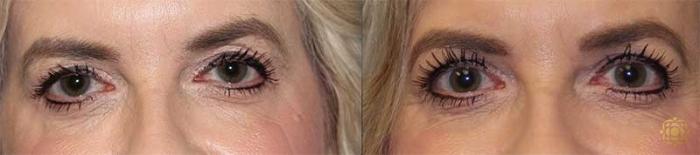 Before & After Blepharoplasty Case 220 Front View in Newport Beach, CA