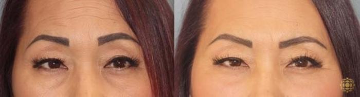Before & After Blepharoplasty Case 252 Front View in Newport Beach, CA