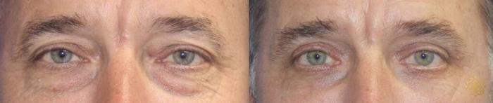 Before & After Blepharoplasty Case 261 View #1 View in Newport Beach, CA