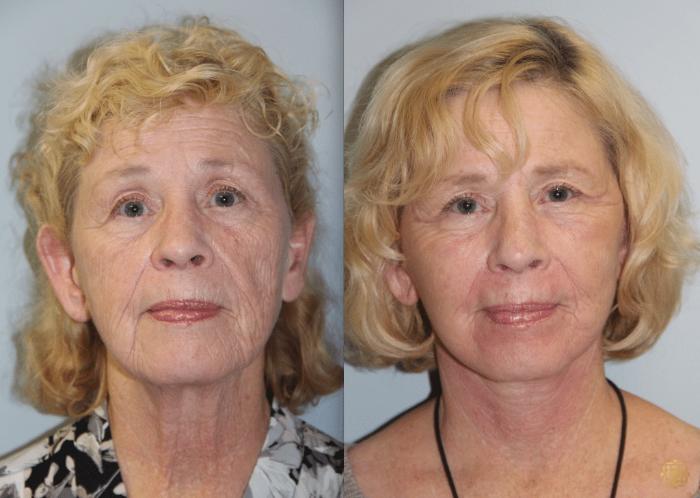 Before & After Chemical Peels Case 392 View #1 View in Newport Beach, CA