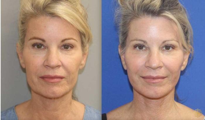 Before & After Fractional CO2 Laser Skin Resurfacing Case 103 Front View in Newport Beach, CA