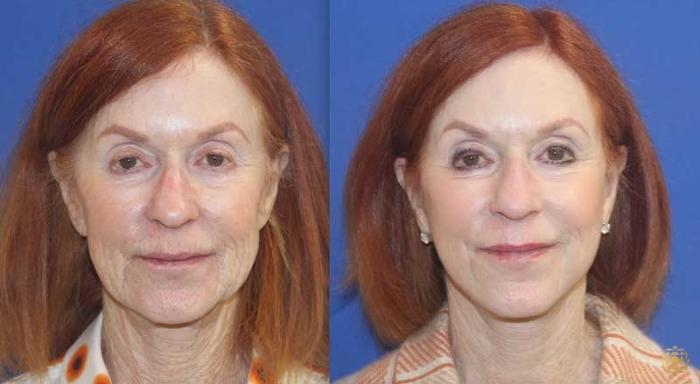 Before & After Fractional CO2 Laser Skin Resurfacing Case 106 Front View in Newport Beach, CA