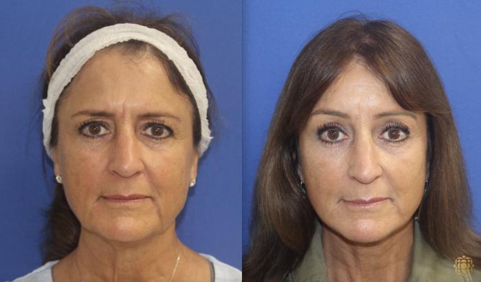 Before & After Face & Neck Lift Case 141 Front View in Newport Beach, CA
