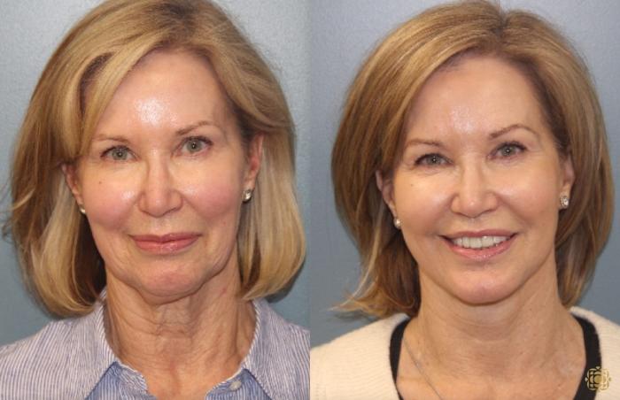 Before & After Face & Neck Lift Case 33 Front View in Newport Beach, CA