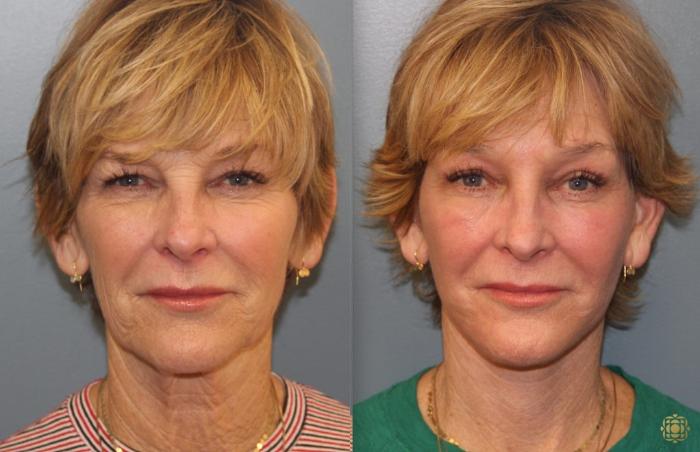 Before & After Fractional CO2 Laser Skin Resurfacing Case 39 Front View in Newport Beach, CA