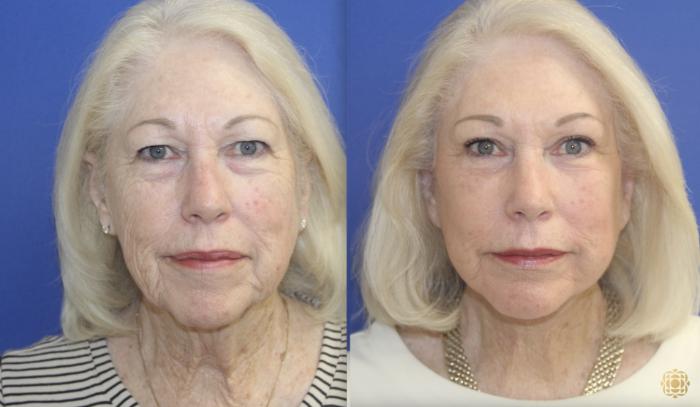 Lower Face and Neck Lift; Temporal Browlift; Upper Blepharoplasty; Lower Blepharoplasty with Fat Transfer; Facial Fat Transfer; Fractional CO2 Laser - FNC