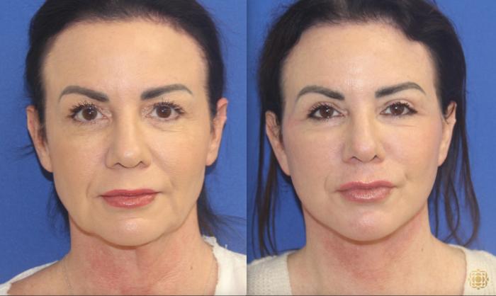 Lower Face and Neck Lift; Upper Blepharoplasty; Fractional CO2 Laser - Periocular