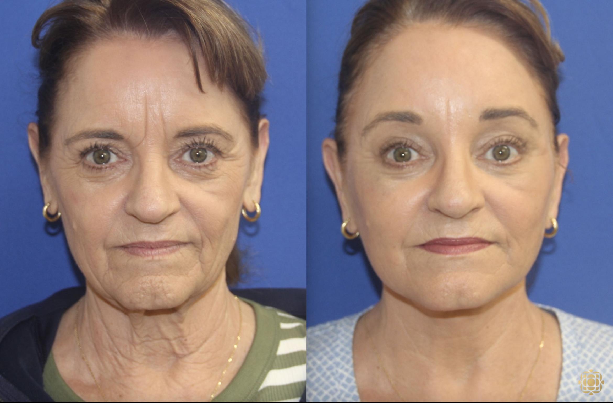 Lower Face and Neck Lift; Browlift; Facial Fat Transfer; Fractional CO2 Laser - Face
