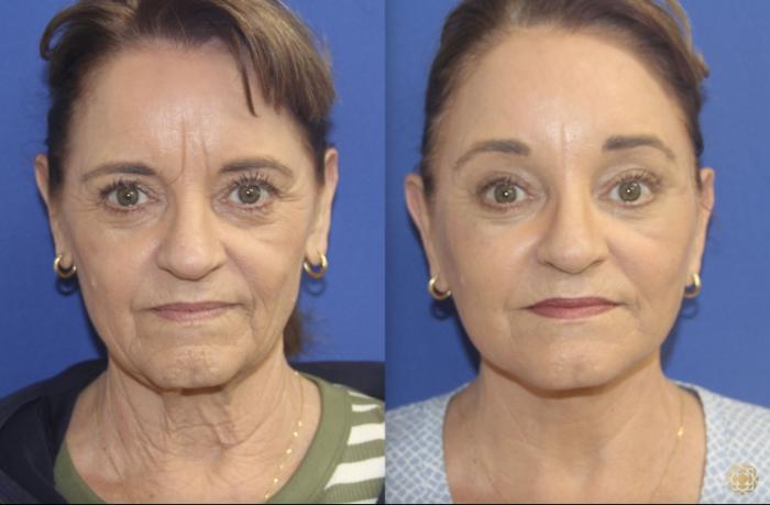 Lower Face and Neck Lift; Browlift; Facial Fat Transfer; Fractional CO2 Laser - Face