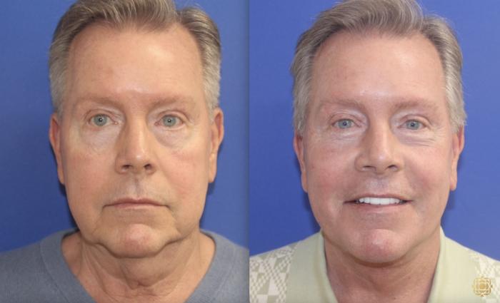 Lower Face and Neck Lift; Buccal Fat Removal