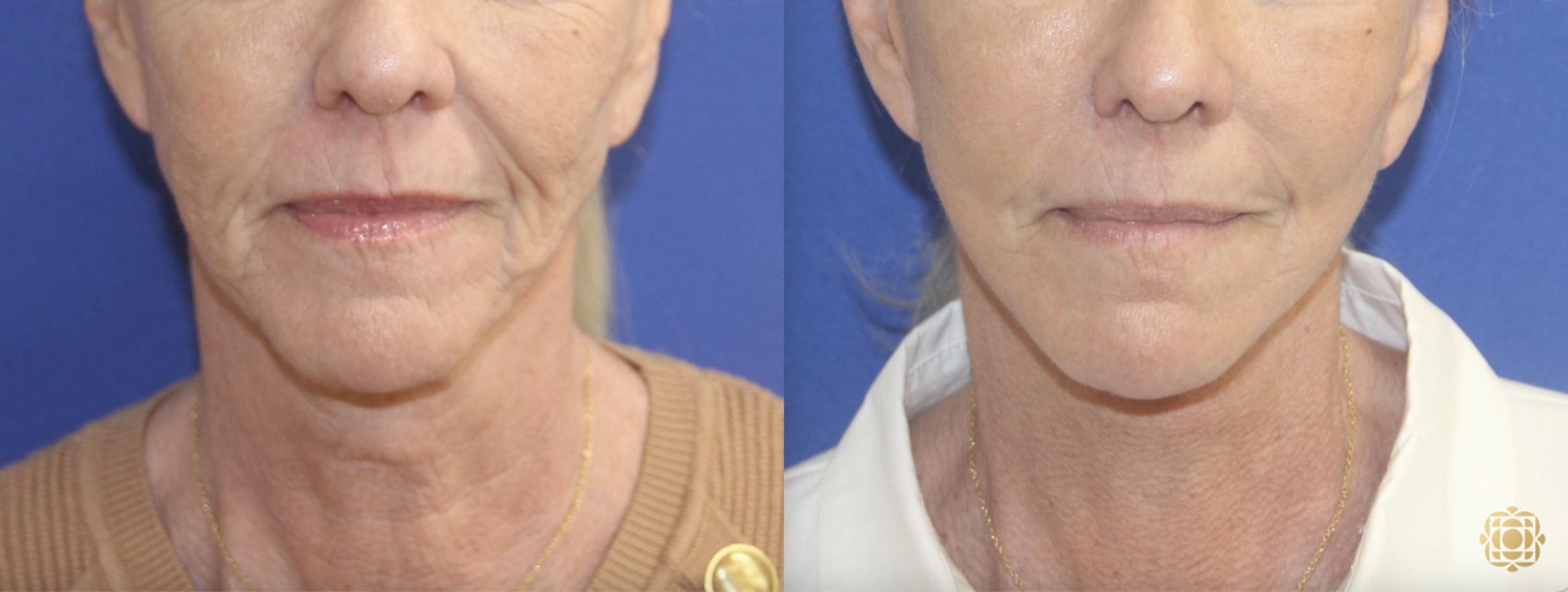 Before & After Face & Neck Lift Case 410 Front View in Newport Beach, CA