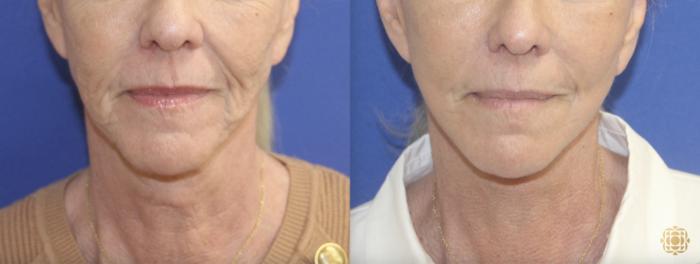 Before & After Facial Fat Grafting Case 410 Front View in Newport Beach, CA