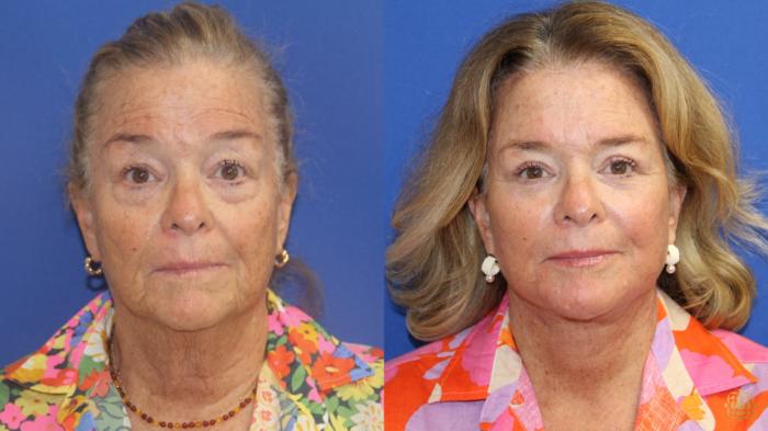 Before & After Blepharoplasty Case 413 Front View in Newport Beach, CA