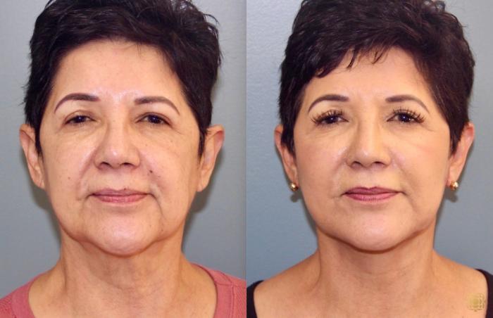 Before & After Face & Neck Lift Case 42 Front View in Newport Beach, CA