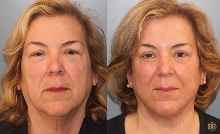 Before & After Fractional CO2 Laser Skin Resurfacing Case 93 Front View in Newport Beach, CA