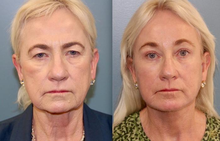 Before & After Fractional CO2 Laser Skin Resurfacing Case 96 Front View in Newport Beach, CA