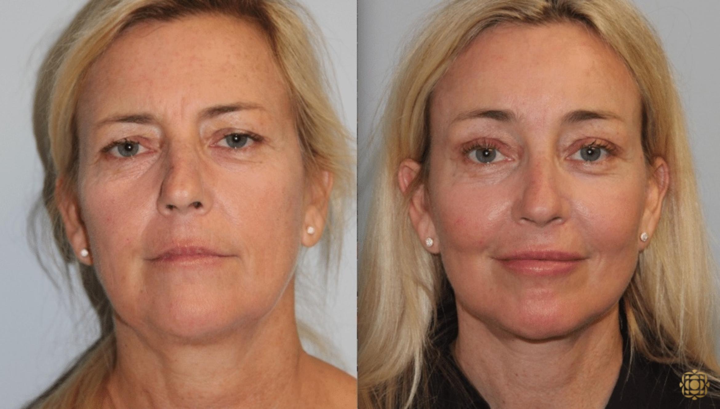Before & After Facial Fat Grafting Case 265 Front View in Newport Beach, CA