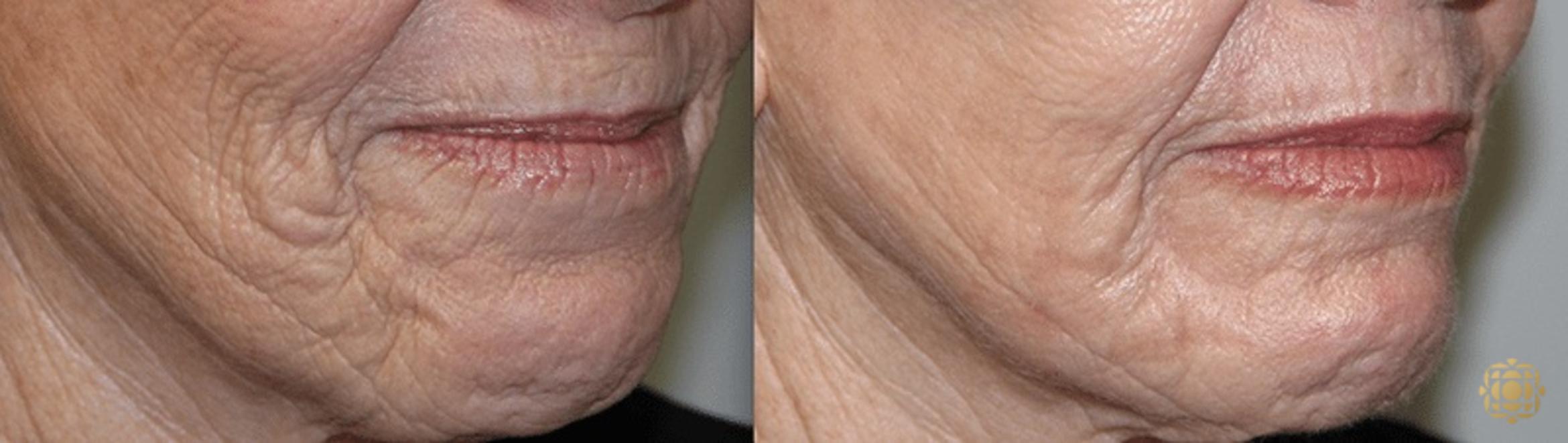 Before & After Fractional CO2 Laser Skin Resurfacing Case 329 View #1 View in Newport Beach, CA
