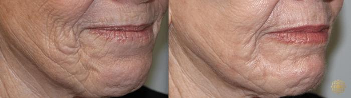 Before & After Fractional CO2 Laser Skin Resurfacing Case 329 View #1 View in Newport Beach, CA
