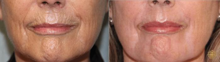 Before & After Fractional CO2 Laser Skin Resurfacing Case 334 View #1 View in Newport Beach, CA