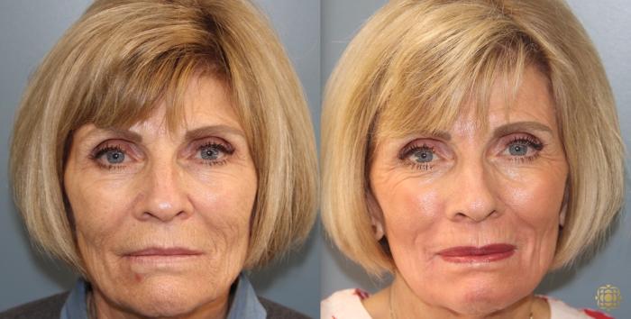 Before & After Fractional CO2 Laser Skin Resurfacing Case 350 Front View in Newport Beach, CA
