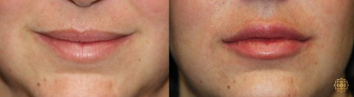 Before & After Injectables Case 374 View #1 View in Newport Beach, CA