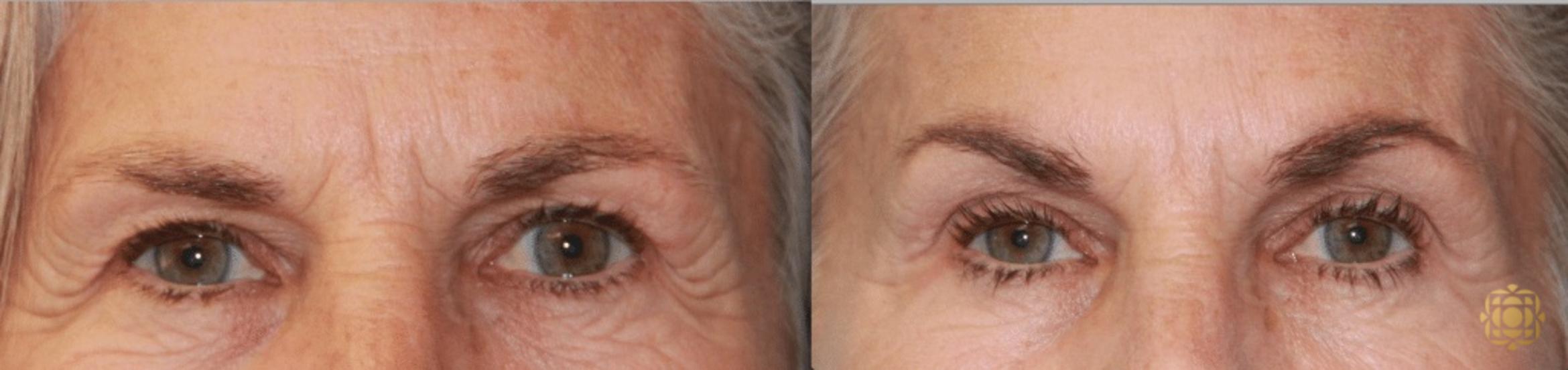 Before & After Injectables Case 376 View #1 View in Newport Beach, CA