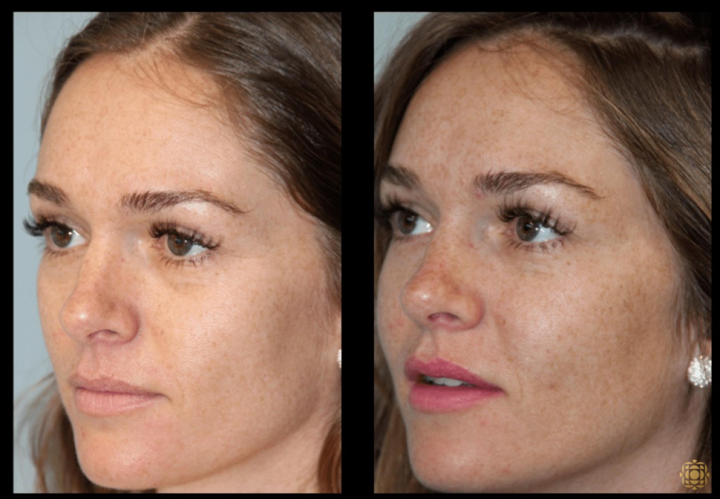 Before & After Injectables Case 379 View #1 View in Newport Beach, CA