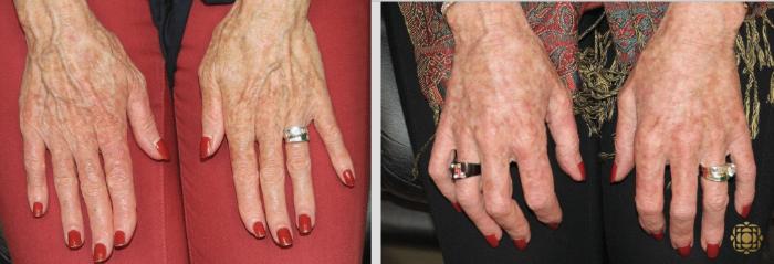 Before & After Injectables Case 381 View #1 View in Newport Beach, CA