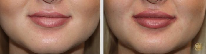 Before & After Injectables Case 387 View #1 View in Newport Beach, CA