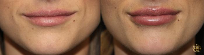 Before & After Injectables Case 389 View #1 View in Newport Beach, CA