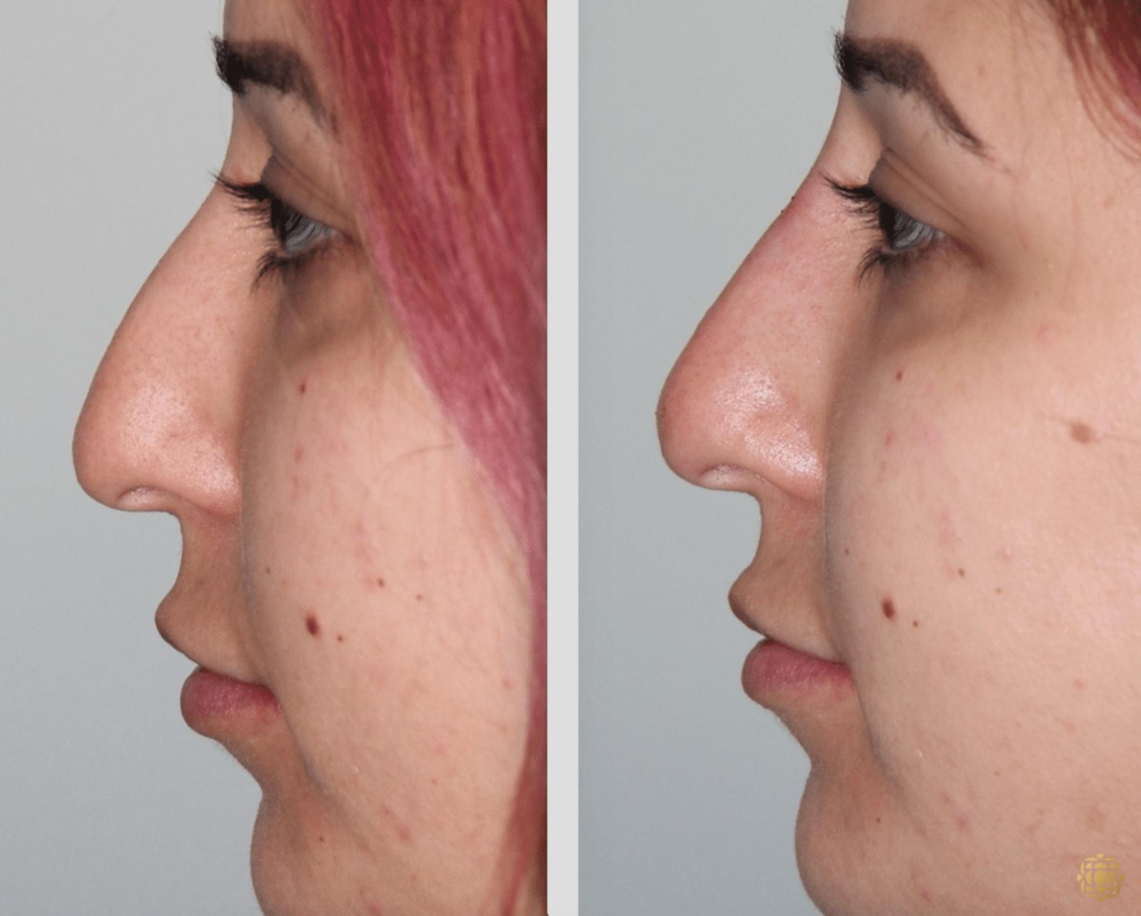 Before & After Injectables Case 390 View #1 View in Newport Beach, CA