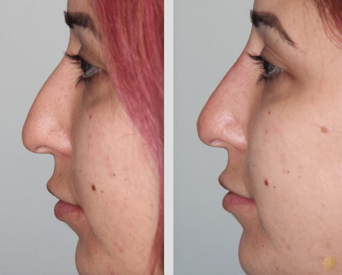 Before & After Injectables Case 390 View #1 View in Newport Beach, CA
