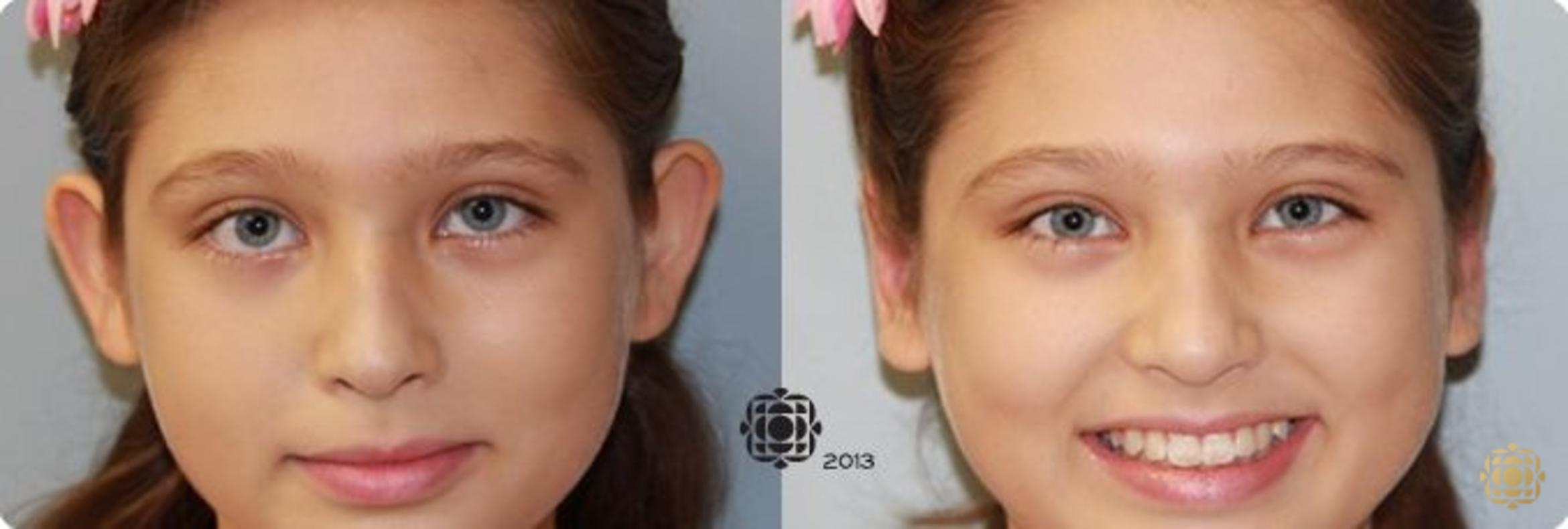 Before & After Otoplasty & Earlobe Repair Case 284 View #1 View in Newport Beach, CA