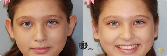 Before & After Otoplasty & Earlobe Repair Case 284 View #1 View in Newport Beach, CA