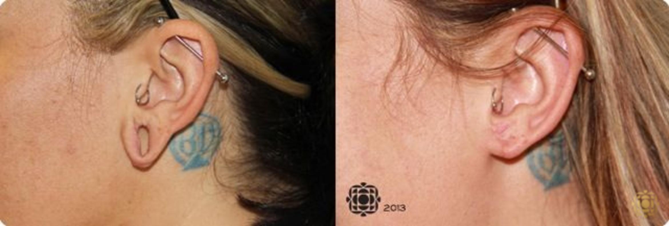 Before & After Otoplasty & Earlobe Repair Case 285 View #1 View in Newport Beach, CA