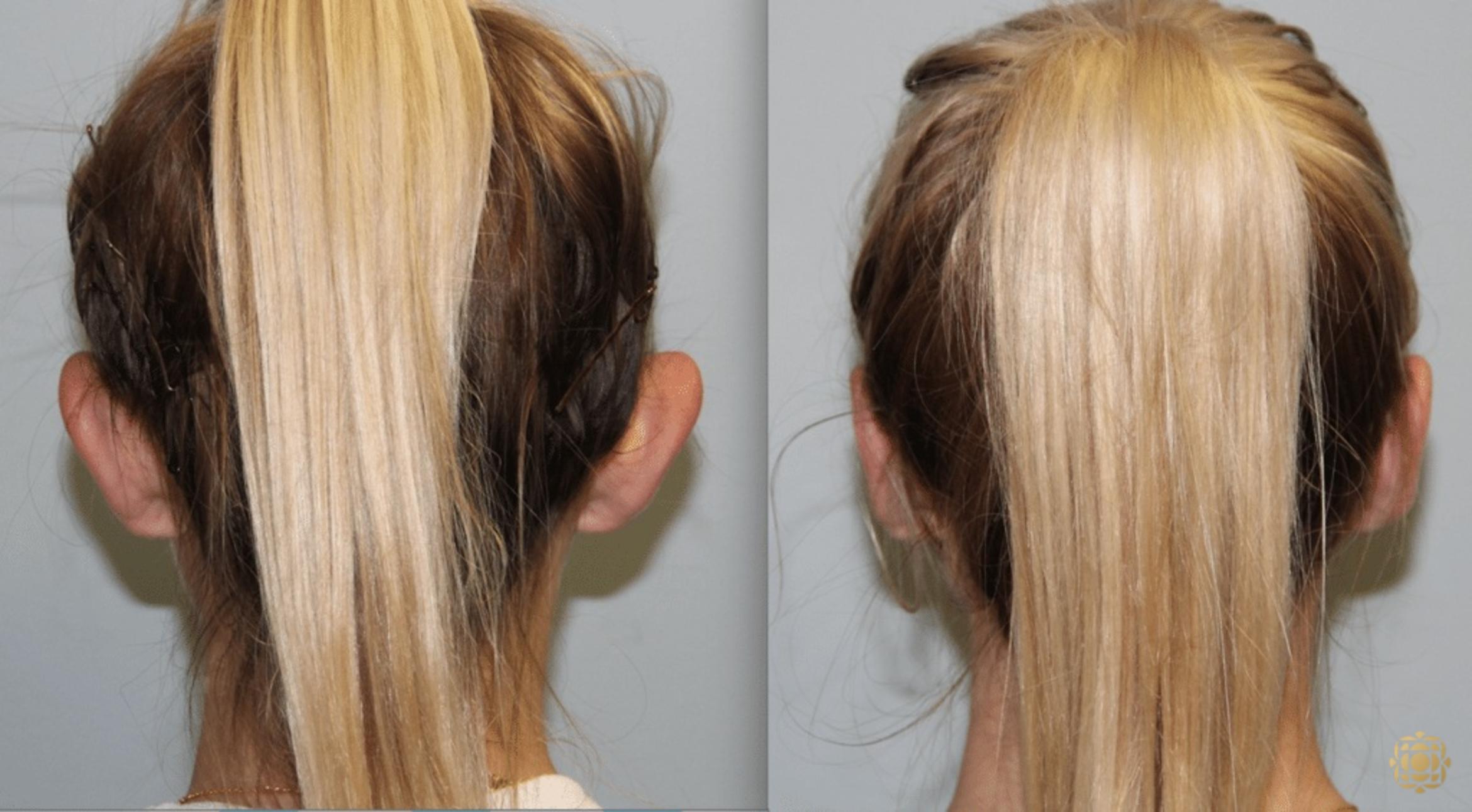 Before & After Otoplasty & Earlobe Repair Case 287 View #1 View in Newport Beach, CA