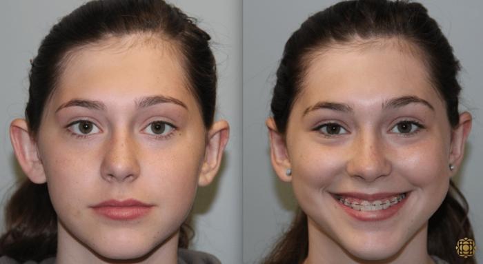 Before & After Otoplasty & Earlobe Repair Case 288 View #1 View in Newport Beach, CA