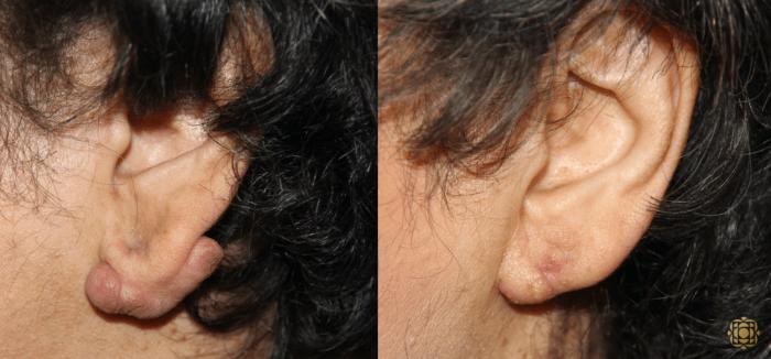 Before & After Otoplasty & Earlobe Repair Case 289 View #1 View in Newport Beach, CA