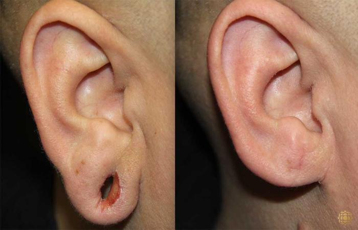 Before & After Otoplasty & Earlobe Repair Case 292 View #1 View in Newport Beach, CA