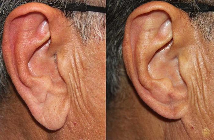 Before & After Otoplasty & Earlobe Repair Case 400 View #1 View in Newport Beach, CA