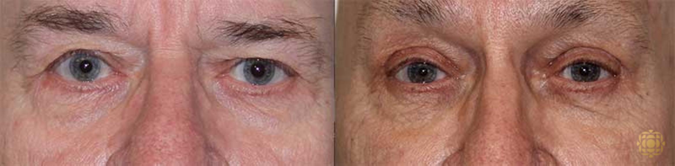 Before & After Blepharoplasty Case 206 View #1 View in Newport Beach, CA