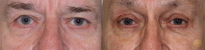 Before & After Blepharoplasty Case 206 View #1 View in Newport Beach, CA