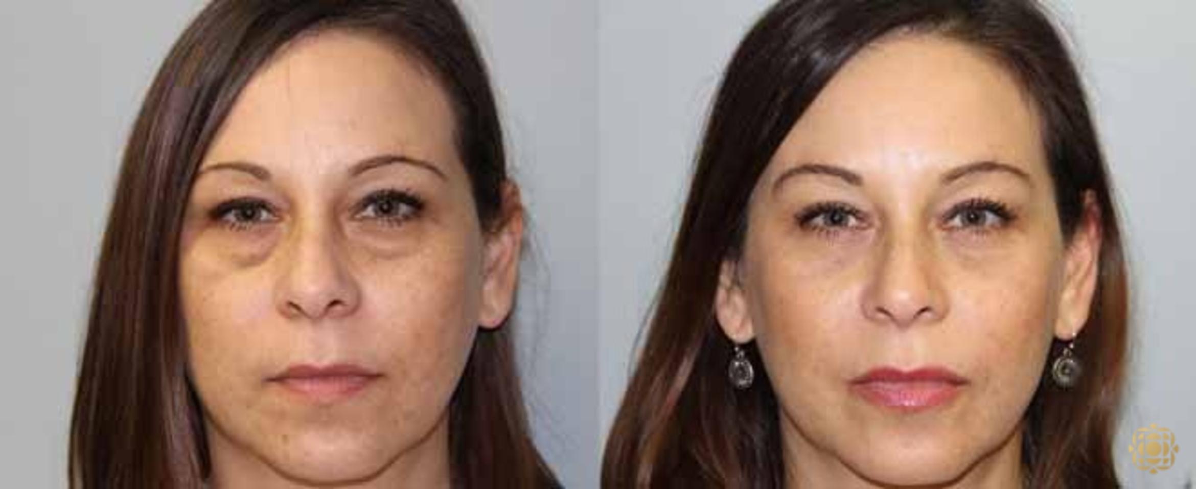 Before & After Blepharoplasty Case 207 View #1 View in Newport Beach, CA