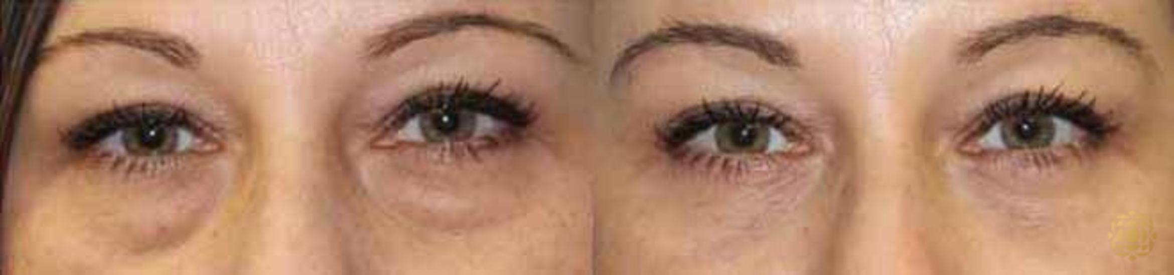 Before & After Blepharoplasty Case 207 View #2 View in Newport Beach, CA