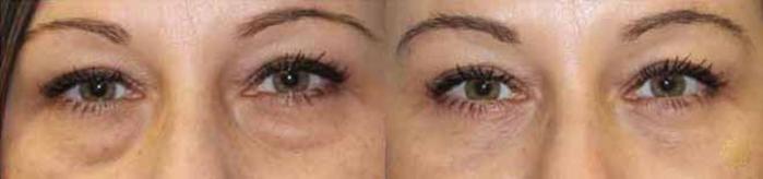 Before & After Blepharoplasty Case 207 View #2 View in Newport Beach, CA